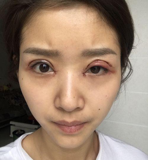 割双眼皮失败的图片,美丽蜕变需谨慎